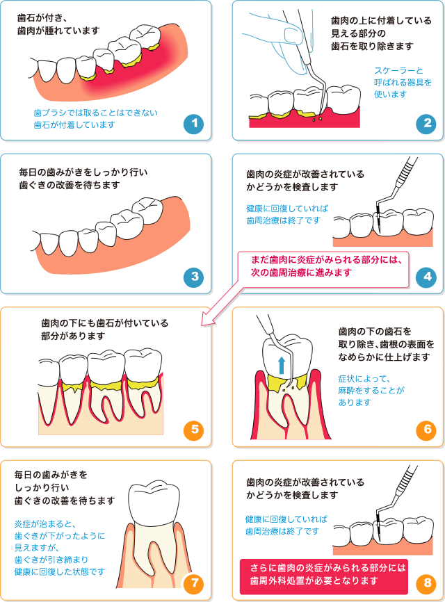 歯周病治療（歯石をとります）