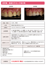 前歯セラミック