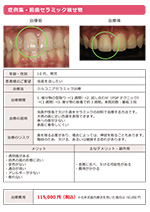 前歯セラミック