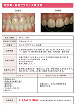前歯セラミック