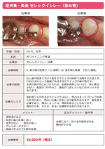 セレックインレー