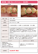 セレックインレー
