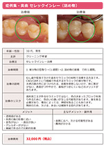 セレックインレー