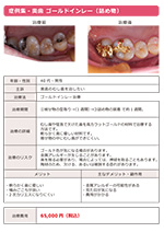 ゴールドインレー（詰め物）