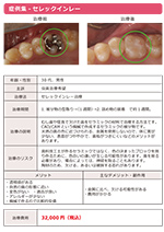 セレックインレー