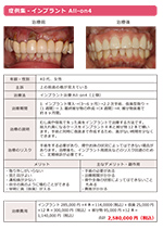 インプラント All-on4