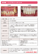 インプラント All-on4