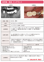 奥歯 インプラント