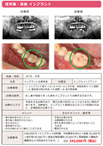 奥歯 インプラント