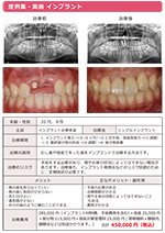 シンプルインプラント