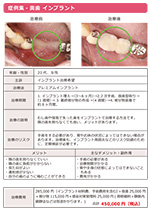 プレミアムインプラント