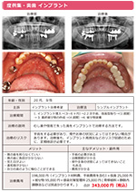 シンプルインプラント