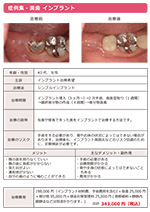 シンプルインプラント