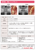 シンプルインプラント