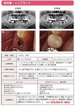 プレミアムインプラント