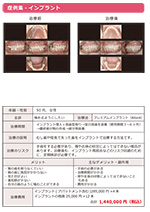 プレミアムインプラント