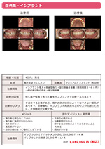 プレミアムインプラント