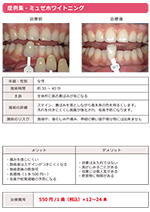 ホワイトニング