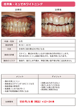 ホワイトニング