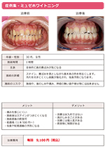 ホワイトニング