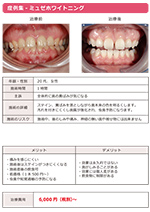 ホワイトニング