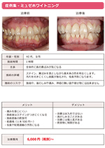ホワイトニング