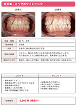 ホワイトニング