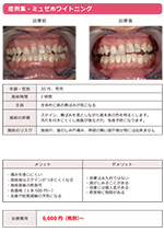 ホワイトニング