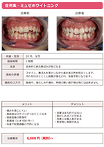 ホワイトニング