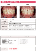 ホワイトニング