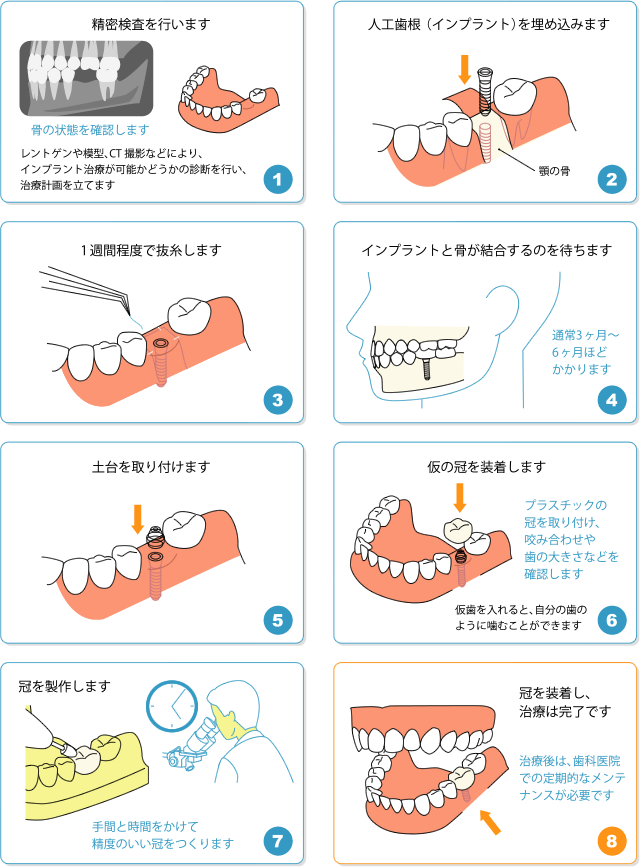 奥歯のインプラントの治療の流れ