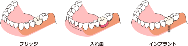 人工的な歯で補う治療には3種類あります