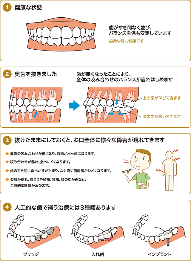 抜けた歯を補うため、部分入れ歯を作ります