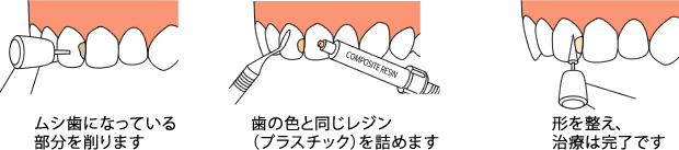 CASE-1：前歯のムシ歯や奥歯の小さいムシ歯には詰め物（レジン充填）を行います。
