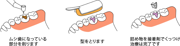 CASE-2：奥歯のムシ歯には詰め物（インレー）を作ります。
