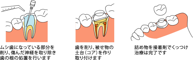 CASE-3：神経まで達した前歯や奥歯のムシ歯には被せもの（クラウン）を作ります。