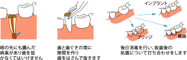 CASE-4：根だけ残して進行したムシ歯（残根）には抜歯を行います。