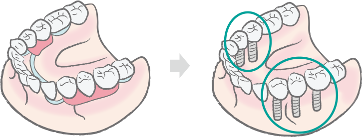 インプラントによる改善ポイント