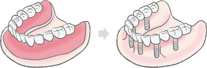 インプラントによる改善ポイント