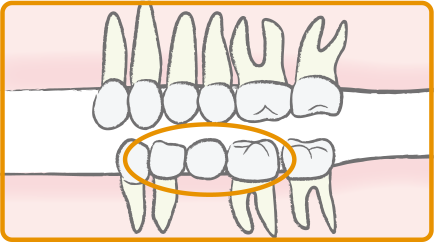 抜歯したまま放置すると