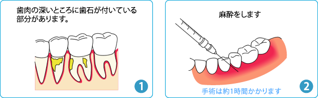 歯周外科処置（フラップ手術）