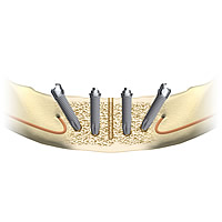 All-on-4で負担の軽減