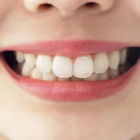 歯周病予防：THP（トータルヘルスプログラム）